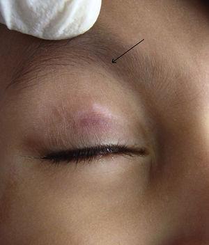 Complete response observed after 4 applications of cantharidin with slight post-imflammatory hypopigmentation.