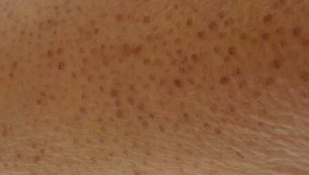Keratosis pilaris